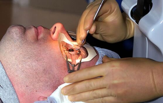 Skleroplastika krátkozrakosti na stabilizáciu videnia