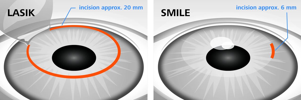 Porovnanie laserových metód korekcie zraku LASIK a SMILE